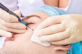 Dermato-Surgery (Minor Skin Procedures)