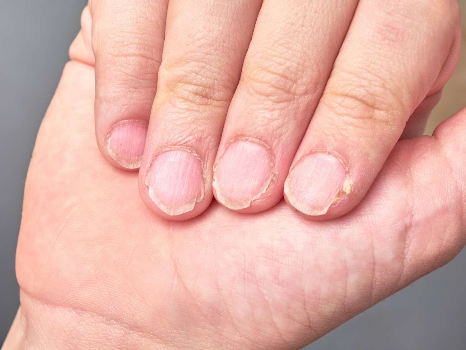 Nail Disorders & Nail Aesthetics
