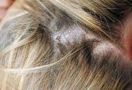 Hair & Scalp Care (Trichology Services)